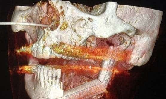 Surgeons use virtual surgery to reconstruct patient’s jaw