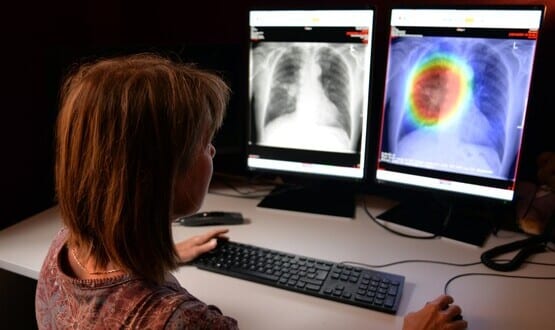 AI in lung cancer diagnosis