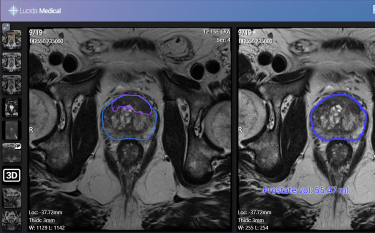 Leeds Teaching Hospitals trials AI prostate cancer diagnosis tool