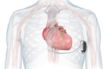 NICE approves remote monitoring tools for heart failure patients