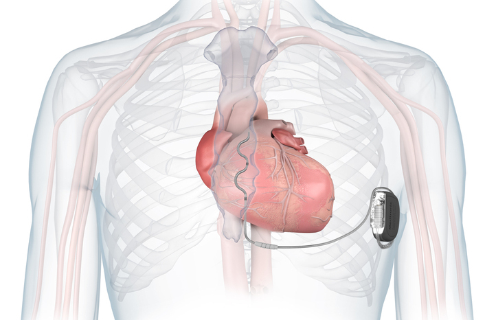 graphic showing placement of ICD devices in chest